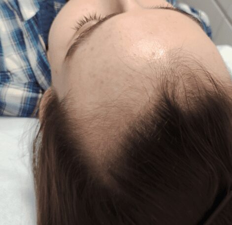 Hair loss image showing a man with a thinning hair line