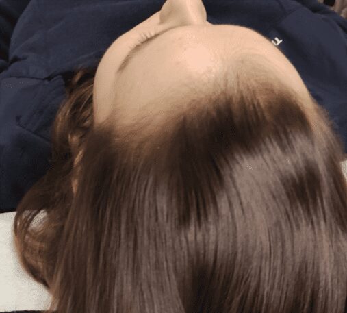 Hair improvements image showing a man with improved hair line
