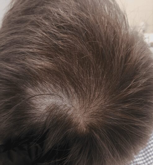 woman with thinning hair